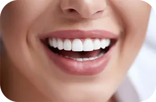 نمونه کار لمینت دندان در کلینیک دندانپزشکی آرتمیس