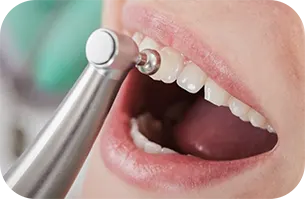 نمونه کار بلیچینگ دندان در کلینیک دندانپزشکی آرتمیس
