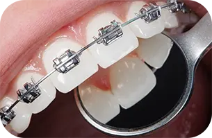 نمونه کار ارتودنسی دندان در کلینیک دندانپزشکی آرتمیس
